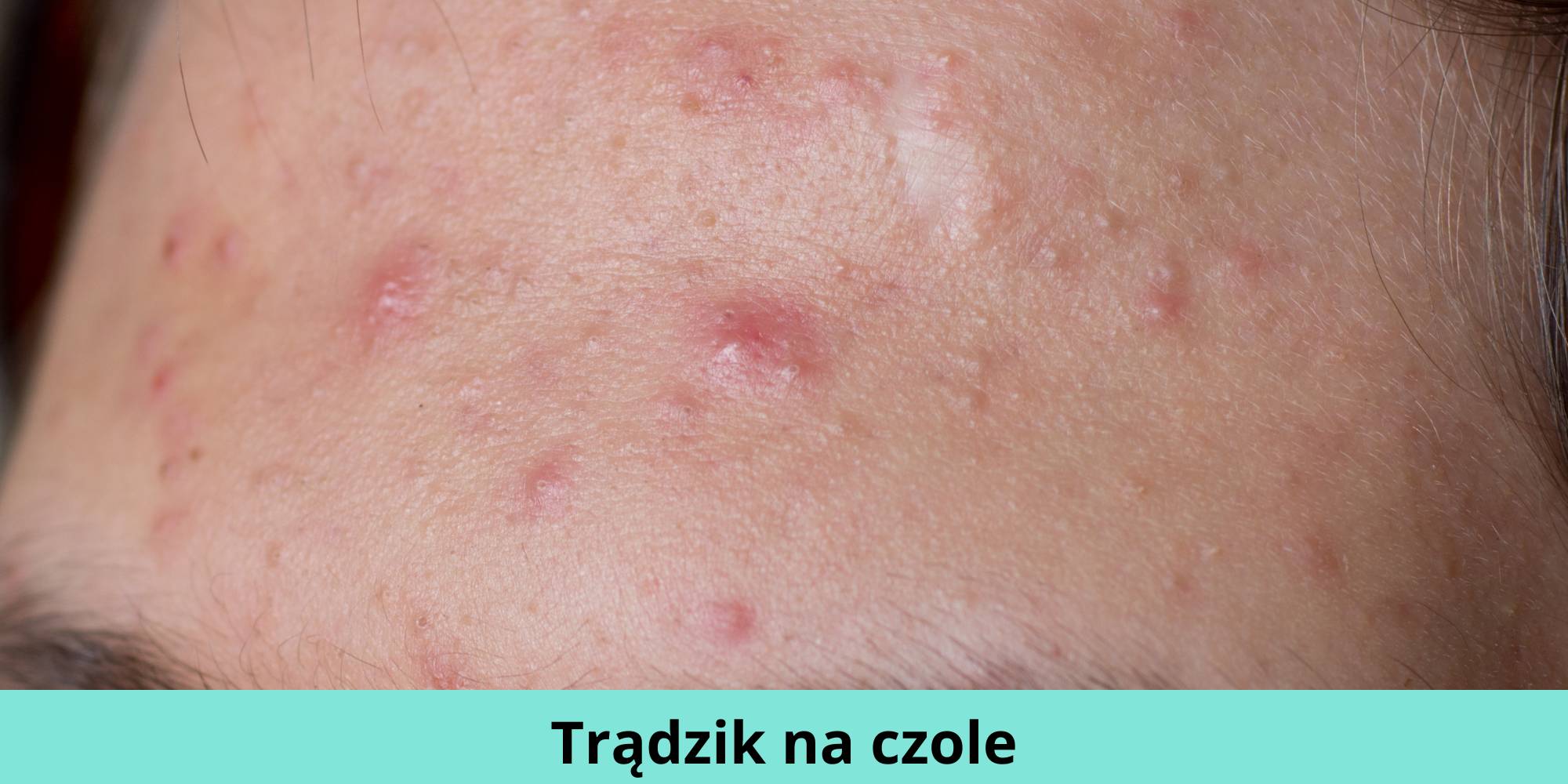 krostki na czole szampon przeciwłupieżowy