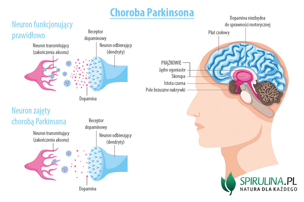 pieluchomajtki w chorobie parkinsona