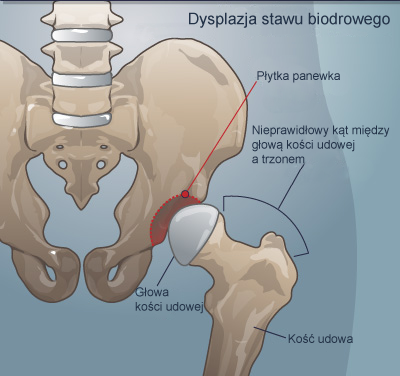 dysplazja stawu biodrowego u niemowląt a pieluchy wielorazowe