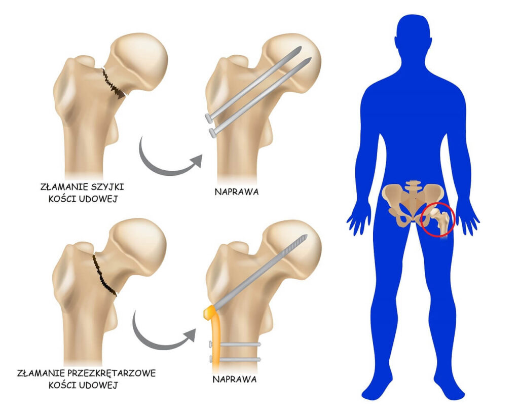 złamanie szyjki kości udowej zmiana pampersa